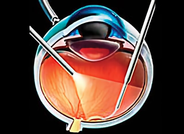 Macular Pucker Treatment | Northern California Advanced Surgery Center